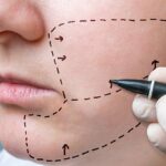 Cheek Augmentation in Abu Dhabi