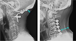 Cervical Spine Surgery