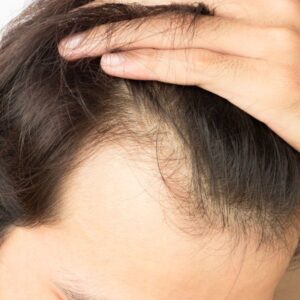 Exploring the Latest Techniques in Hair Transplantation Dubai