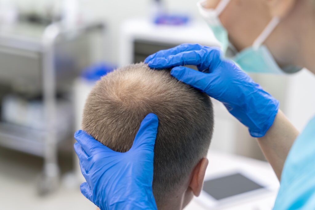 Cost of hair transplant