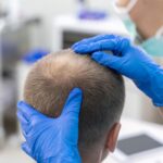 Cost of hair transplant