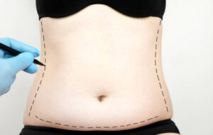 Lipo Abdominoplasty: A Journey of Discovery