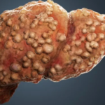 Global Liver fibrosis Market is a significant global health concern caused by various factors like viral hepatitis, alcohol abuse, and non-alcoholic fatty liver disease (NAFLD). The liver fibrosis market, valued at USD 2,317.7 million in 2023, is experiencing considerable growth, driven by the increasing incidence of liver-related conditions and rising awareness among the public. The market is projected to grow at a compound annual growth rate (CAGR) of 7.7% from 2024 to 2032, reaching a valuation of USD 4,518.6 million by 2032. This article delves into the key drivers, market segmentation, trends, and future outlook of the liver fibrosis market. Understanding Liver Fibrosis Liver fibrosis is the accumulation of excessive scar tissue in the liver due to continuous injury or inflammation. It is a progressive condition that, if left untreated, can lead to liver cirrhosis, liver failure, and an increased risk of hepatocellular carcinoma (liver cancer). Early diagnosis and intervention are crucial for managing liver fibrosis, which has spurred research and development efforts in diagnostic tools and treatment options. The main causes of liver fibrosis include: Chronic viral hepatitis (hepatitis B and C): These viral infections cause inflammation and damage to liver tissues, resulting in fibrosis. Alcoholic liver disease (ALD): Long-term alcohol abuse can lead to liver inflammation and fibrosis. Non-alcoholic fatty liver disease (NAFLD): The increasing prevalence of obesity and diabetes has resulted in a rise in NAFLD cases, which can progress to fibrosis. Get a Free Sample Report with Table of Contents: https://www.expertmarketresearch.com/reports/liver-fibrosis-market/requestsample Market Drivers 1. Rising Incidence of Liver Fibrosis The prevalence of liver fibrosis is on the rise, driven by the increasing number of cases of hepatitis, alcohol abuse, and metabolic conditions like obesity and diabetes. As the global population continues to age and experience higher rates of these contributing factors, liver fibrosis is becoming more common, especially in developed and emerging economies. 2. Increased Awareness and Diagnosis With advancements in medical diagnostics and a growing awareness of liver diseases, more patients are being diagnosed with liver fibrosis at earlier stages. Non-invasive imaging techniques such as transient elastography (FibroScan) and serum biomarkers have made it easier to detect fibrosis without the need for liver biopsy, further driving market growth. 3. Advances in Treatment Options Although there is no specific cure for liver fibrosis, treatments aimed at reducing inflammation, managing underlying conditions (like hepatitis or fatty liver), and preventing progression to cirrhosis are gaining momentum. The development of antifibrotic drugs is a key area of research, with several pharmaceutical companies exploring novel therapies that target fibrosis directly. 4. Government Initiatives and Public Health Programs Many governments and health organizations are launching awareness campaigns and implementing programs to prevent and manage liver diseases. For example, public health initiatives focusing on hepatitis vaccination and alcohol consumption reduction have contributed to increasing awareness and early diagnosis, which positively impacts the liver fibrosis market. Read Full Report with Table of Contents: https://www.expertmarketresearch.com/reports/liver-fibrosis-market Market Segmentation The liver fibrosis market can be segmented into various categories based on treatment type, diagnostics, end-users, and regions. 1. By Treatment Type Antifibrotic Drugs: Emerging as one of the most promising treatment areas, antifibrotic drugs are designed to prevent or reverse liver fibrosis. These drugs inhibit the activation of hepatic stellate cells, which are primarily responsible for fibrogenesis. Hepatitis C and B Treatments: Antiviral therapies for hepatitis B and C play a significant role in preventing liver fibrosis. Effective management of these chronic infections can halt or reverse the progression of fibrosis. Lifestyle Changes and Supportive Therapies: Patients with liver fibrosis often benefit from lifestyle modifications, including weight management, dietary changes, and alcohol cessation. Supportive therapies also include medications to reduce inflammation and oxidative stress in the liver. 2. By Diagnostics Non-invasive Imaging Techniques: Technologies like transient elastography (FibroScan), magnetic resonance elastography (MRE), and ultrasound elastography are gaining popularity as non-invasive methods to assess liver stiffness and fibrosis. These diagnostic tools are playing a crucial role in market growth. Serum Biomarkers: Blood tests measuring biomarkers like ALT, AST, and fibrosis markers such as hyaluronic acid, procollagen III peptide, and alpha-2-macroglobulin are helping detect liver fibrosis early. 3. By End Users Hospitals: Hospitals account for a significant share of the liver fibrosis market, as they are the primary centers for diagnosing and treating liver diseases. Diagnostic Laboratories: These laboratories play a critical role in conducting tests for liver function and fibrosis assessment, contributing to market expansion. Specialty Clinics: Clinics focusing on liver health and gastroenterology are becoming key players in the diagnosis and management of liver fibrosis, offering more personalized care. 4. By Region North America: North America holds the largest share of the liver fibrosis market due to a high prevalence of hepatitis and NAFLD, increasing healthcare expenditure, and advanced diagnostic infrastructure. Europe: Europe follows closely, driven by government initiatives for hepatitis prevention and the growing burden of fatty liver diseases. Asia Pacific: The Asia Pacific region is expected to witness significant growth due to rising healthcare awareness, a growing population, and an increasing prevalence of liver diseases. Latin America and the Middle East: These regions are also expected to see considerable growth due to improved access to healthcare services and rising awareness of liver health. Market Trends 1. Development of Antifibrotic Therapies Pharmaceutical companies are heavily investing in research and development to create antifibrotic therapies that can either halt or reverse the progression of liver fibrosis. Currently, there is no FDA-approved antifibrotic drug specifically for liver fibrosis, but ongoing clinical trials suggest that breakthroughs in this area could significantly impact the market. 2. Non-invasive Diagnostic Tools The shift from invasive liver biopsies to non-invasive diagnostic tools is gaining momentum. Non-invasive tests are not only safer but also more cost-effective, making them an attractive option for widespread use. The increasing use of FibroScan, MRI, and other elastography techniques is expected to drive the diagnostics segment of the liver fibrosis market. 3. Combination Therapies Combining antifibrotic drugs with other treatments such as antiviral medications, lifestyle changes, and immune modulators is becoming a popular strategy in clinical practice. This multi-faceted approach enhances treatment efficacy and is likely to become a standard in managing liver fibrosis in the future. Challenges Facing the Market 1. Lack of Approved Antifibrotic Drugs Despite ongoing research, there is a limited number of effective and approved drugs specifically targeting liver fibrosis. The absence of curative therapies poses a challenge for healthcare providers, and more clinical research is needed to identify breakthrough treatments. 2. High Treatment Costs The cost of liver fibrosis treatment can be a barrier, particularly in developing countries where healthcare resources are limited. The expense of antiviral medications, diagnostic tests, and liver transplantation is prohibitive for many patients, which could hinder market growth. 3. Limited Awareness in Developing Regions While liver fibrosis awareness is growing in developed countries, many developing regions still face challenges in educating the public about liver health. Poor access to diagnostic facilities and healthcare infrastructure also limits early detection and treatment in these areas. Future Outlook The future of the liver fibrosis market looks promising, with continued advancements in diagnostic technologies and antifibrotic drug development. The increasing prevalence of liver diseases, coupled with heightened awareness and early diagnosis, is expected to drive the market’s growth through 2032. Key Developments to Watch Antifibrotic Drug Approvals: Pharmaceutical companies working on novel antifibrotic therapies are likely to see regulatory approvals in the coming years, marking a significant milestone in liver fibrosis treatment. Integration of AI in Diagnostics: Artificial intelligence and machine learning algorithms are being explored to enhance the accuracy of liver fibrosis detection and grading, potentially revolutionizing diagnostics. Public Health Initiatives: Governments and health organizations are expected to continue raising awareness about liver fibrosis and related conditions, promoting preventive measures such as hepatitis vaccination and alcohol moderation. About Us Acquire unparalleled access to critical industry insights with our comprehensive market research reports, meticulously prepared by a team of seasoned experts. These reports are designed to equip decision-makers with an in-depth understanding of prevailing market trends, competitive landscapes, and growth opportunities. Our high-quality, data-driven analysis provides the essential framework for organisations seeking to make informed and strategic decisions in an increasingly complex and rapidly evolving business environment. By investing in our market research reports, you can ensure your organisation remains agile, proactive, and poised for success in today’s competitive market. Don’t miss the opportunity to elevate your business intelligence and strengthen your strategic planning. Secure your organisation’s future success by acquiring one of our Expert Market Research reports today. Media Contact Company Name: Claight Corporation Contact Person: James william, Corporate Sales Specialist Email: sales@expertmarketresearch.com Toll Free Number: +1-415-325-5166 | +44-702-402-5790 Address: 30 North Gould Street, Sheridan, WY 82801, USA Website: www.expertmarketresearch.com Related Trending Reports https://www.expertmarketresearch.com/reports/holter-ecg-market https://www.expertmarketresearch.com/reports/polycystic-kidney-disease-drugs-market Global Liver Fibrosis Market