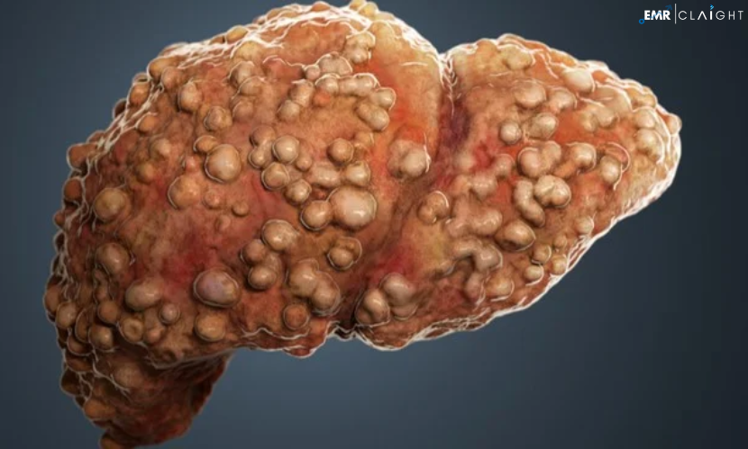 Global Liver fibrosis Market is a significant global health concern caused by various factors like viral hepatitis, alcohol abuse, and non-alcoholic fatty liver disease (NAFLD). The liver fibrosis market, valued at USD 2,317.7 million in 2023, is experiencing considerable growth, driven by the increasing incidence of liver-related conditions and rising awareness among the public. The market is projected to grow at a compound annual growth rate (CAGR) of 7.7% from 2024 to 2032, reaching a valuation of USD 4,518.6 million by 2032. This article delves into the key drivers, market segmentation, trends, and future outlook of the liver fibrosis market. Understanding Liver Fibrosis Liver fibrosis is the accumulation of excessive scar tissue in the liver due to continuous injury or inflammation. It is a progressive condition that, if left untreated, can lead to liver cirrhosis, liver failure, and an increased risk of hepatocellular carcinoma (liver cancer). Early diagnosis and intervention are crucial for managing liver fibrosis, which has spurred research and development efforts in diagnostic tools and treatment options. The main causes of liver fibrosis include: Chronic viral hepatitis (hepatitis B and C): These viral infections cause inflammation and damage to liver tissues, resulting in fibrosis. Alcoholic liver disease (ALD): Long-term alcohol abuse can lead to liver inflammation and fibrosis. Non-alcoholic fatty liver disease (NAFLD): The increasing prevalence of obesity and diabetes has resulted in a rise in NAFLD cases, which can progress to fibrosis. Get a Free Sample Report with Table of Contents: https://www.expertmarketresearch.com/reports/liver-fibrosis-market/requestsample Market Drivers 1. Rising Incidence of Liver Fibrosis The prevalence of liver fibrosis is on the rise, driven by the increasing number of cases of hepatitis, alcohol abuse, and metabolic conditions like obesity and diabetes. As the global population continues to age and experience higher rates of these contributing factors, liver fibrosis is becoming more common, especially in developed and emerging economies. 2. Increased Awareness and Diagnosis With advancements in medical diagnostics and a growing awareness of liver diseases, more patients are being diagnosed with liver fibrosis at earlier stages. Non-invasive imaging techniques such as transient elastography (FibroScan) and serum biomarkers have made it easier to detect fibrosis without the need for liver biopsy, further driving market growth. 3. Advances in Treatment Options Although there is no specific cure for liver fibrosis, treatments aimed at reducing inflammation, managing underlying conditions (like hepatitis or fatty liver), and preventing progression to cirrhosis are gaining momentum. The development of antifibrotic drugs is a key area of research, with several pharmaceutical companies exploring novel therapies that target fibrosis directly. 4. Government Initiatives and Public Health Programs Many governments and health organizations are launching awareness campaigns and implementing programs to prevent and manage liver diseases. For example, public health initiatives focusing on hepatitis vaccination and alcohol consumption reduction have contributed to increasing awareness and early diagnosis, which positively impacts the liver fibrosis market. Read Full Report with Table of Contents: https://www.expertmarketresearch.com/reports/liver-fibrosis-market Market Segmentation The liver fibrosis market can be segmented into various categories based on treatment type, diagnostics, end-users, and regions. 1. By Treatment Type Antifibrotic Drugs: Emerging as one of the most promising treatment areas, antifibrotic drugs are designed to prevent or reverse liver fibrosis. These drugs inhibit the activation of hepatic stellate cells, which are primarily responsible for fibrogenesis. Hepatitis C and B Treatments: Antiviral therapies for hepatitis B and C play a significant role in preventing liver fibrosis. Effective management of these chronic infections can halt or reverse the progression of fibrosis. Lifestyle Changes and Supportive Therapies: Patients with liver fibrosis often benefit from lifestyle modifications, including weight management, dietary changes, and alcohol cessation. Supportive therapies also include medications to reduce inflammation and oxidative stress in the liver. 2. By Diagnostics Non-invasive Imaging Techniques: Technologies like transient elastography (FibroScan), magnetic resonance elastography (MRE), and ultrasound elastography are gaining popularity as non-invasive methods to assess liver stiffness and fibrosis. These diagnostic tools are playing a crucial role in market growth. Serum Biomarkers: Blood tests measuring biomarkers like ALT, AST, and fibrosis markers such as hyaluronic acid, procollagen III peptide, and alpha-2-macroglobulin are helping detect liver fibrosis early. 3. By End Users Hospitals: Hospitals account for a significant share of the liver fibrosis market, as they are the primary centers for diagnosing and treating liver diseases. Diagnostic Laboratories: These laboratories play a critical role in conducting tests for liver function and fibrosis assessment, contributing to market expansion. Specialty Clinics: Clinics focusing on liver health and gastroenterology are becoming key players in the diagnosis and management of liver fibrosis, offering more personalized care. 4. By Region North America: North America holds the largest share of the liver fibrosis market due to a high prevalence of hepatitis and NAFLD, increasing healthcare expenditure, and advanced diagnostic infrastructure. Europe: Europe follows closely, driven by government initiatives for hepatitis prevention and the growing burden of fatty liver diseases. Asia Pacific: The Asia Pacific region is expected to witness significant growth due to rising healthcare awareness, a growing population, and an increasing prevalence of liver diseases. Latin America and the Middle East: These regions are also expected to see considerable growth due to improved access to healthcare services and rising awareness of liver health. Market Trends 1. Development of Antifibrotic Therapies Pharmaceutical companies are heavily investing in research and development to create antifibrotic therapies that can either halt or reverse the progression of liver fibrosis. Currently, there is no FDA-approved antifibrotic drug specifically for liver fibrosis, but ongoing clinical trials suggest that breakthroughs in this area could significantly impact the market. 2. Non-invasive Diagnostic Tools The shift from invasive liver biopsies to non-invasive diagnostic tools is gaining momentum. Non-invasive tests are not only safer but also more cost-effective, making them an attractive option for widespread use. The increasing use of FibroScan, MRI, and other elastography techniques is expected to drive the diagnostics segment of the liver fibrosis market. 3. Combination Therapies Combining antifibrotic drugs with other treatments such as antiviral medications, lifestyle changes, and immune modulators is becoming a popular strategy in clinical practice. This multi-faceted approach enhances treatment efficacy and is likely to become a standard in managing liver fibrosis in the future. Challenges Facing the Market 1. Lack of Approved Antifibrotic Drugs Despite ongoing research, there is a limited number of effective and approved drugs specifically targeting liver fibrosis. The absence of curative therapies poses a challenge for healthcare providers, and more clinical research is needed to identify breakthrough treatments. 2. High Treatment Costs The cost of liver fibrosis treatment can be a barrier, particularly in developing countries where healthcare resources are limited. The expense of antiviral medications, diagnostic tests, and liver transplantation is prohibitive for many patients, which could hinder market growth. 3. Limited Awareness in Developing Regions While liver fibrosis awareness is growing in developed countries, many developing regions still face challenges in educating the public about liver health. Poor access to diagnostic facilities and healthcare infrastructure also limits early detection and treatment in these areas. Future Outlook The future of the liver fibrosis market looks promising, with continued advancements in diagnostic technologies and antifibrotic drug development. The increasing prevalence of liver diseases, coupled with heightened awareness and early diagnosis, is expected to drive the market’s growth through 2032. Key Developments to Watch Antifibrotic Drug Approvals: Pharmaceutical companies working on novel antifibrotic therapies are likely to see regulatory approvals in the coming years, marking a significant milestone in liver fibrosis treatment. Integration of AI in Diagnostics: Artificial intelligence and machine learning algorithms are being explored to enhance the accuracy of liver fibrosis detection and grading, potentially revolutionizing diagnostics. Public Health Initiatives: Governments and health organizations are expected to continue raising awareness about liver fibrosis and related conditions, promoting preventive measures such as hepatitis vaccination and alcohol moderation. About Us Acquire unparalleled access to critical industry insights with our comprehensive market research reports, meticulously prepared by a team of seasoned experts. These reports are designed to equip decision-makers with an in-depth understanding of prevailing market trends, competitive landscapes, and growth opportunities. Our high-quality, data-driven analysis provides the essential framework for organisations seeking to make informed and strategic decisions in an increasingly complex and rapidly evolving business environment. By investing in our market research reports, you can ensure your organisation remains agile, proactive, and poised for success in today’s competitive market. Don’t miss the opportunity to elevate your business intelligence and strengthen your strategic planning. Secure your organisation’s future success by acquiring one of our Expert Market Research reports today. Media Contact Company Name: Claight Corporation Contact Person: James william, Corporate Sales Specialist Email: sales@expertmarketresearch.com Toll Free Number: +1-415-325-5166 | +44-702-402-5790 Address: 30 North Gould Street, Sheridan, WY 82801, USA Website: www.expertmarketresearch.com Related Trending Reports https://www.expertmarketresearch.com/reports/holter-ecg-market https://www.expertmarketresearch.com/reports/polycystic-kidney-disease-drugs-market Global Liver Fibrosis Market