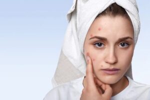 Pimples Treatment uae