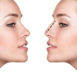 Rhinoplasty in Dubai