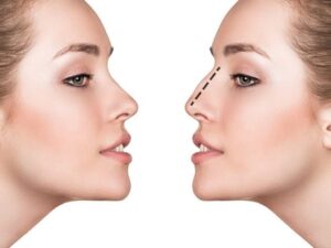 Rhinoplasty in Dubai