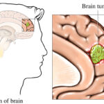 brain tumor