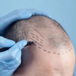 تكلفة زراعة الشعر في دبي