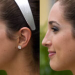 Everything You Need to Know About Rhinoplasty