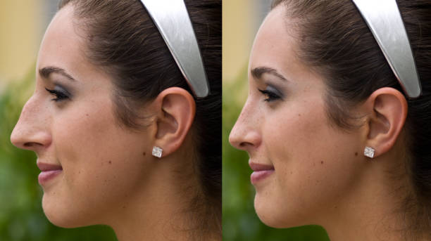 Everything You Need to Know About Rhinoplasty