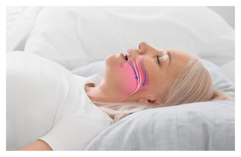 Alternatives to CPAP