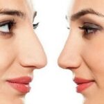 chirurgo rinoplastica