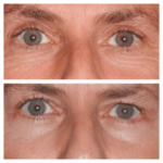 Eye bag removal in Dubai