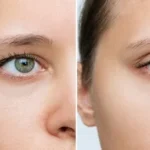 Celebrity-Inspired Blepharoplasty Dubai