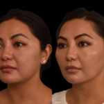 Double chin removal in Dubai