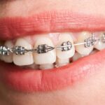 Does Dental Braces Require Special Oral Care?