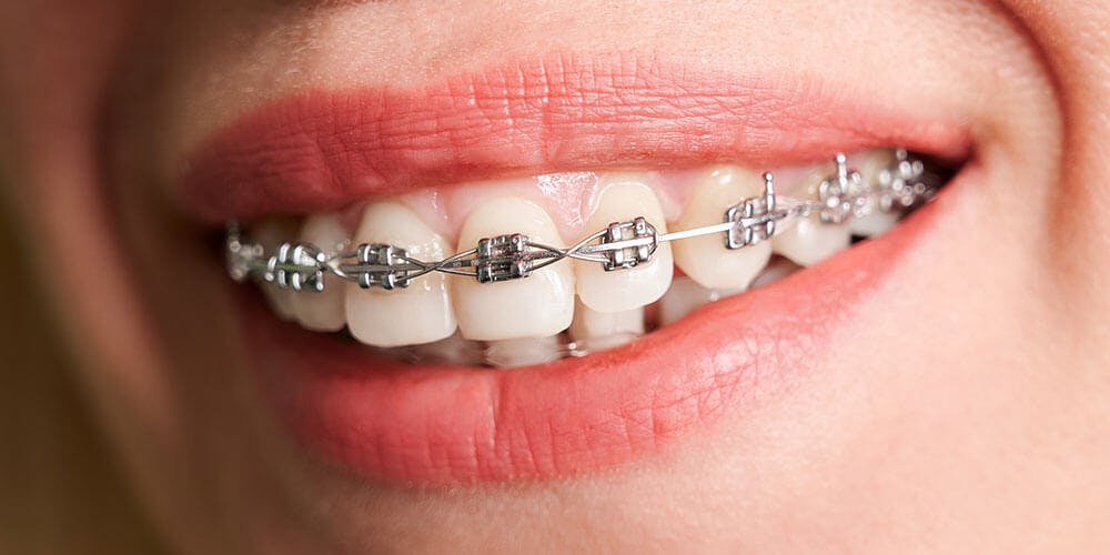 Does Dental Braces Require Special Oral Care?
