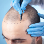 Does GFC Treatment for Hair Really Stop Hair Loss