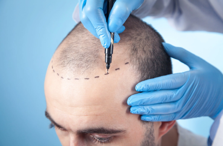 Does GFC Treatment for Hair Really Stop Hair Loss
