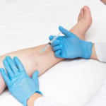 Does Varicose Veins Treatment Prevent Future Veins