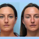 Best Plastic Surgeon in Dubai for Face Chin and Neck Thread Lift