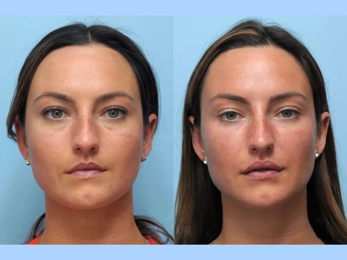Restore Facial Firmness with Thread Lift by Best Plastic Surgeons in Dubai