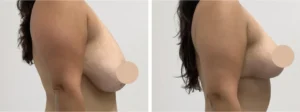breast lift in dubai