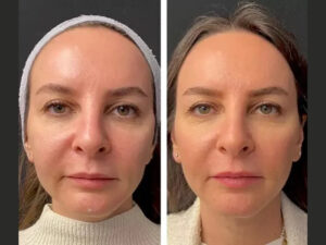 Mesotherapy in dubai,