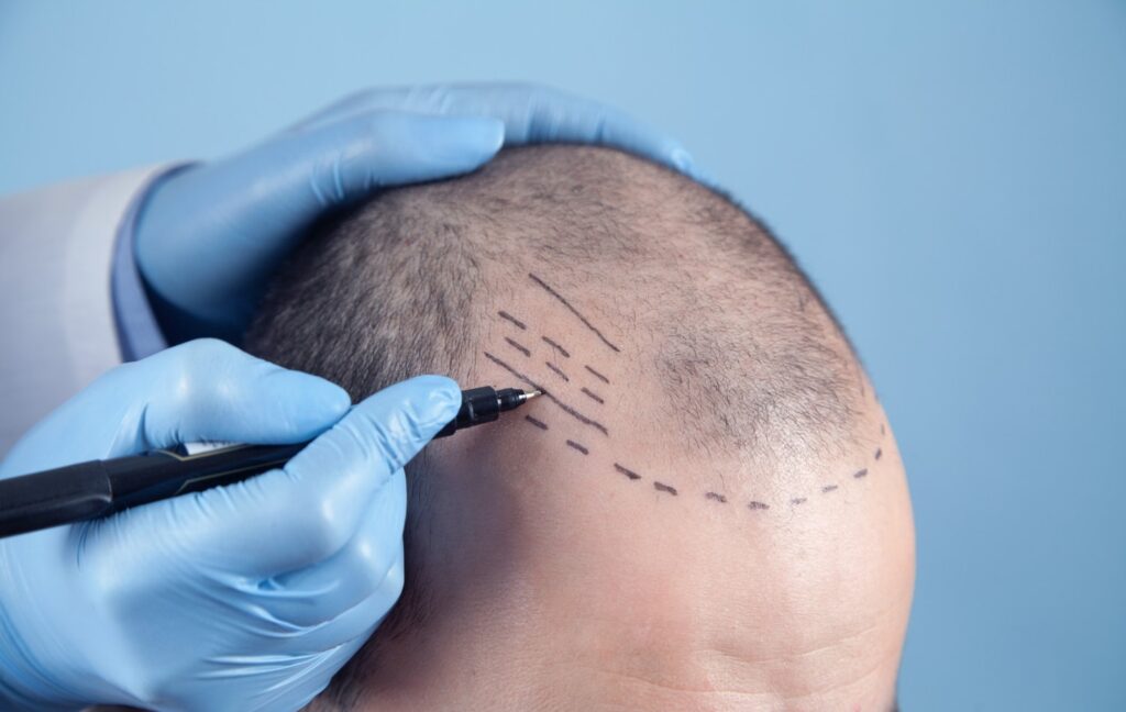 How Painful Is an FUE Hair Transplant Surgery?
