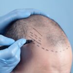 How Painful Is an FUE Hair Transplant Surgery?