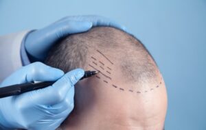 How Painful Is an FUE Hair Transplant Surgery?