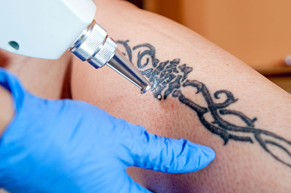 How Quickly Will You See Results From Laser Tattoo Removal?
