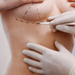 Is Areola Reduction Suitable for All Ages?