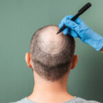 Is Crown Hair Transplant Permanent or Temporary Solution