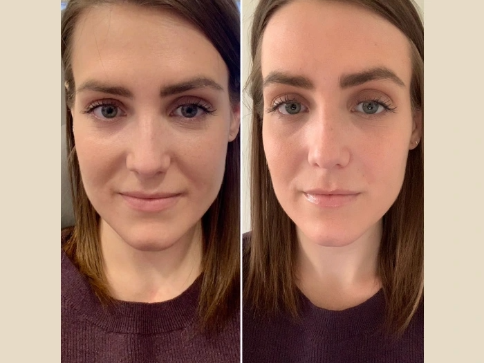 PRP Treatment in Dubai