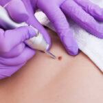 What Causes Warts to Return After Removal