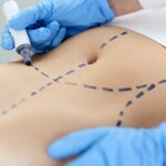What to Expect From Mini Abdominoplasty Surgery