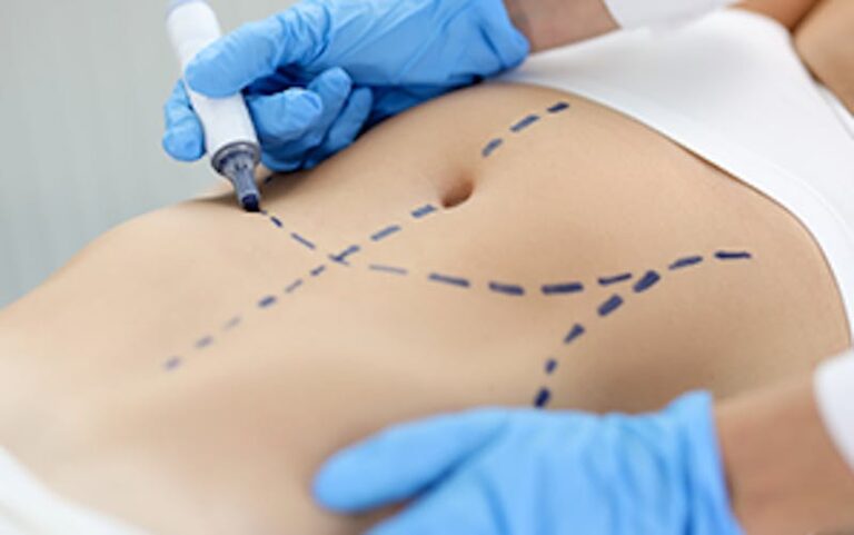 What to Expect From Mini Abdominoplasty Surgery
