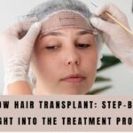 Eyebrow Hair Transplant: Step-by-Step Insight Into the Treatment Process