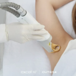 Laser Hair Removal at The Medispa: Safe, Effective & Long-Lasting Hair Reduction
