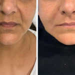 Dermal Fillers in Telford, Shrewsbury, Wolverhampton & Walsall – The Medispa