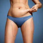 Best Abdominoplasty in Dubai