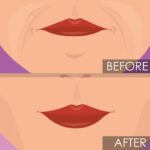 lip lift