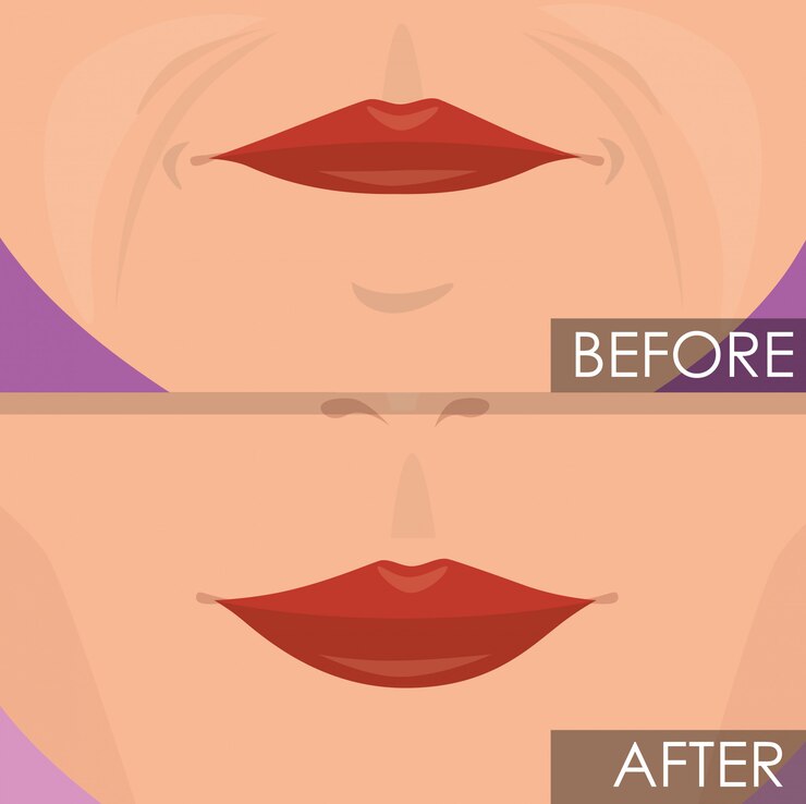 lip lift
