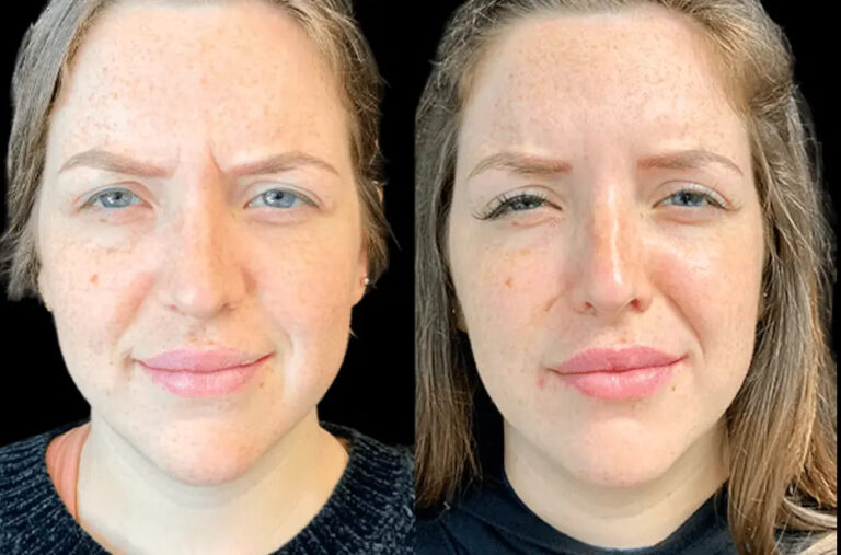 Best Doctors in dubai for Botox Treatment Safety and Aftercare