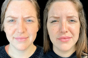 Best Aesthetic Clinic in Dubai Explains Botox Injections and Recovery