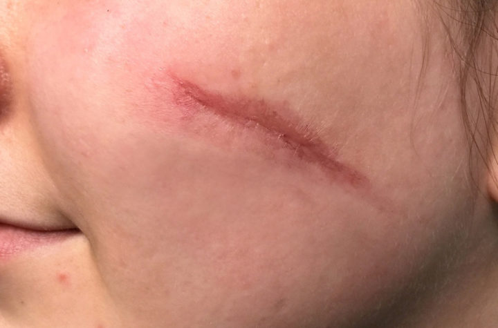 Can Facial Scar Revision Fade Long-Standing Scars