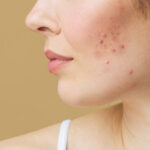 Can Laser Acne Scar treatment Boost Confidence