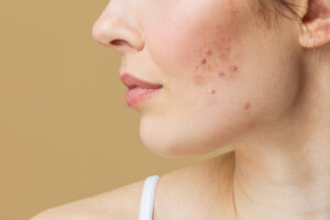 Can Laser Acne Scar treatment Boost Confidence